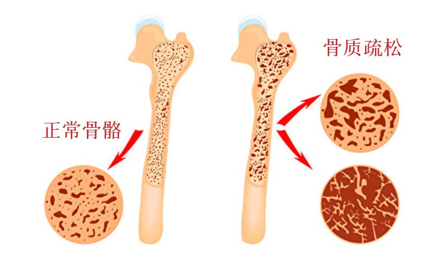 强烈建议骨质疏松的人多运动，科学依据与实际指导