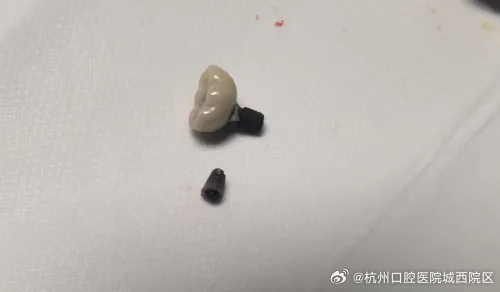 男子遭遇罕见病例，14颗牙掉落，剩余14颗亦需全拔