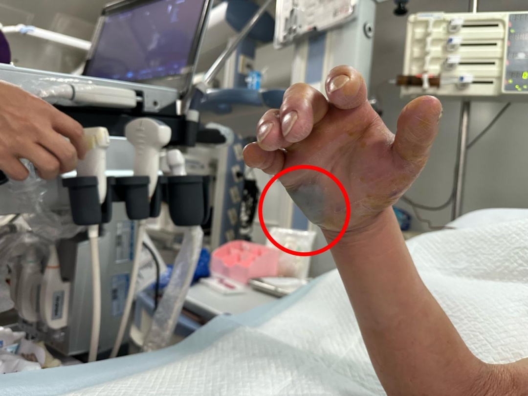 男子竹林劳作不慎，竹屑刺伤致破伤风，惊险入ICU