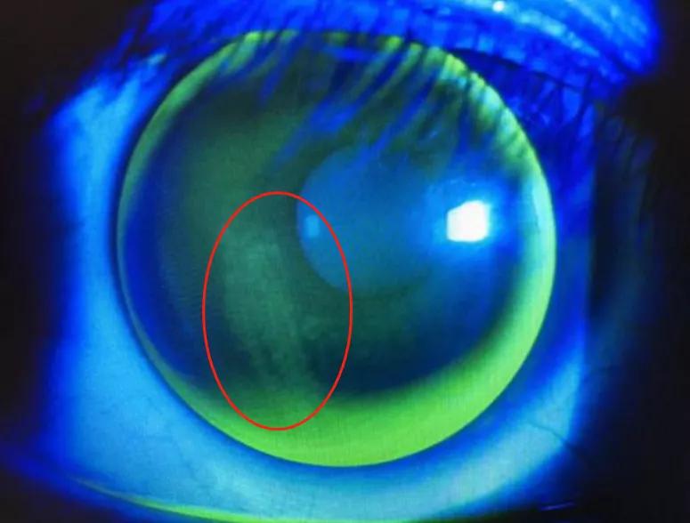 男子戴隐形眼镜半年未摘致无法取出，警惕隐形眼镜的隐形风险