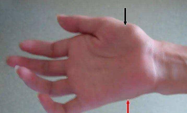 高中生左手莫名发抖半年,确诊平山病,一场无声的挑战 高中生左手莫名发抖半年,确诊平山病,一场无声的挑战